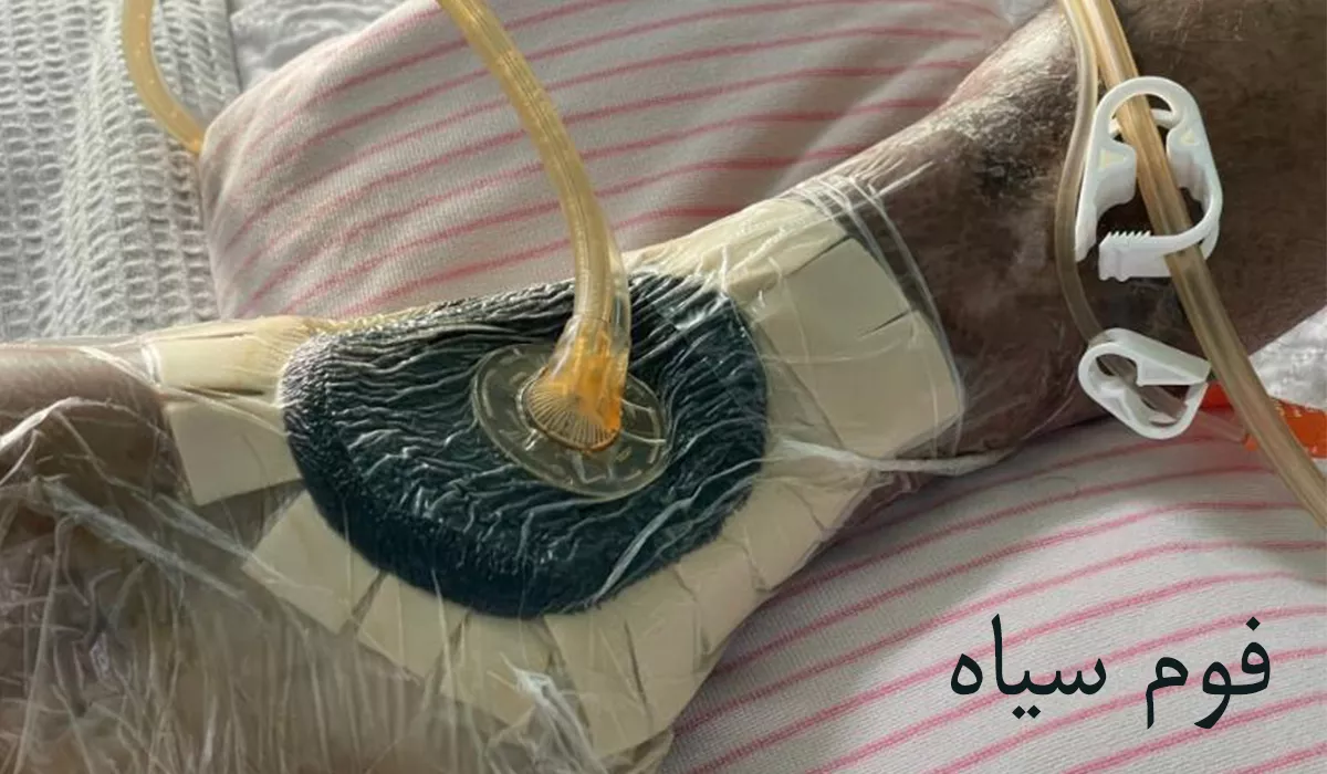 فوم سیاه وکیوم تراپی
