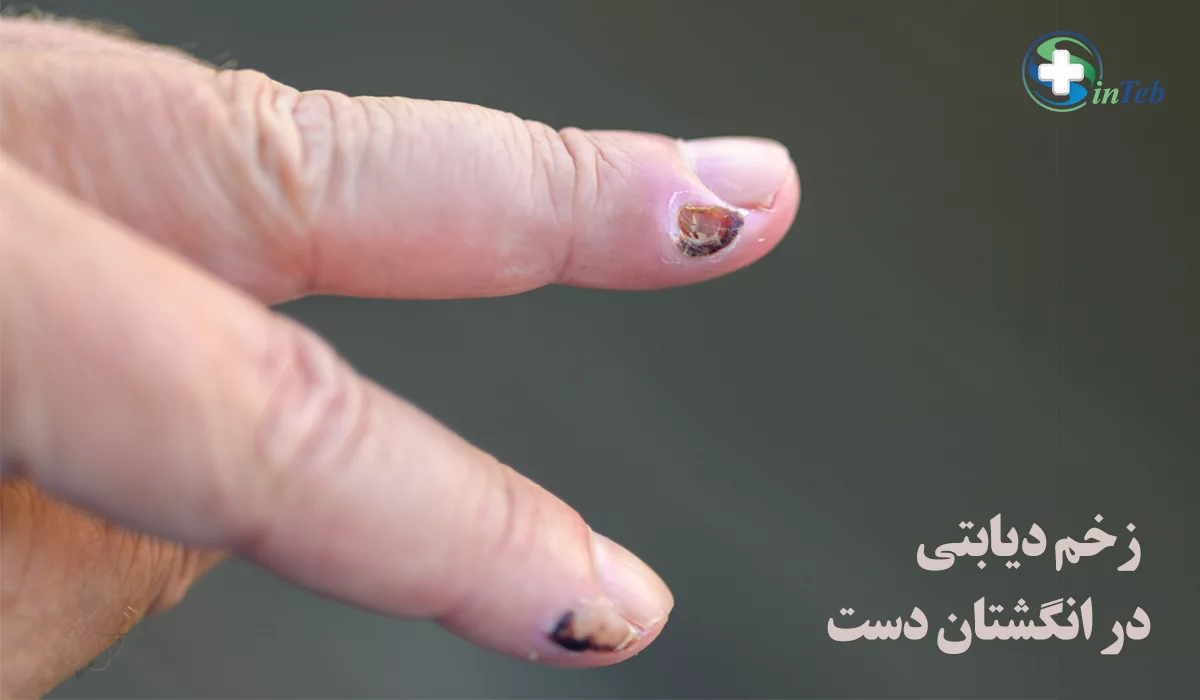 زخم دیابتی