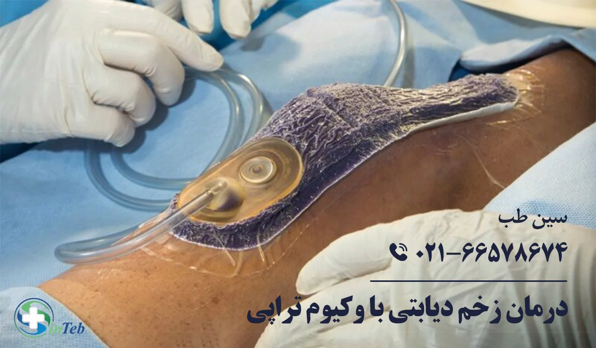 درمان زخم دیابتی با وکیوم تراپی