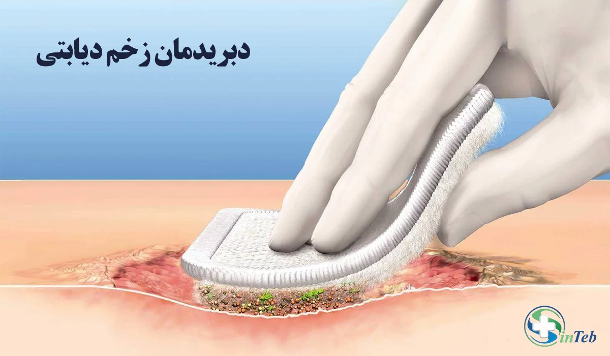 دبریدمان زخم دیابتی