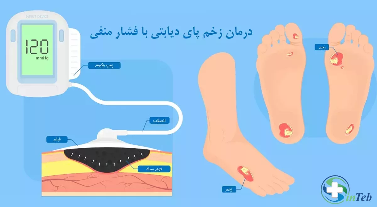 درمان زخم دیابتی با وکیوم تراپی