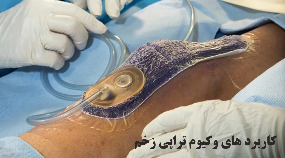 کاربردهای وکیوم تراپی زخم