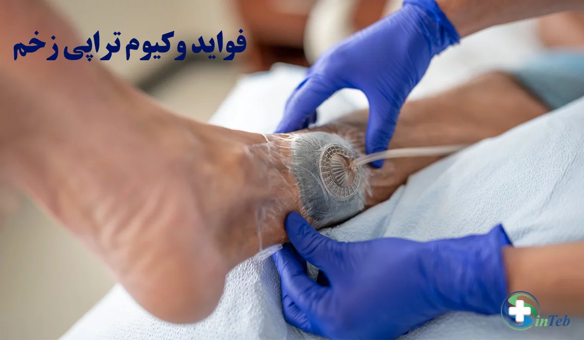 فواید وکیوم تراپی زخم
