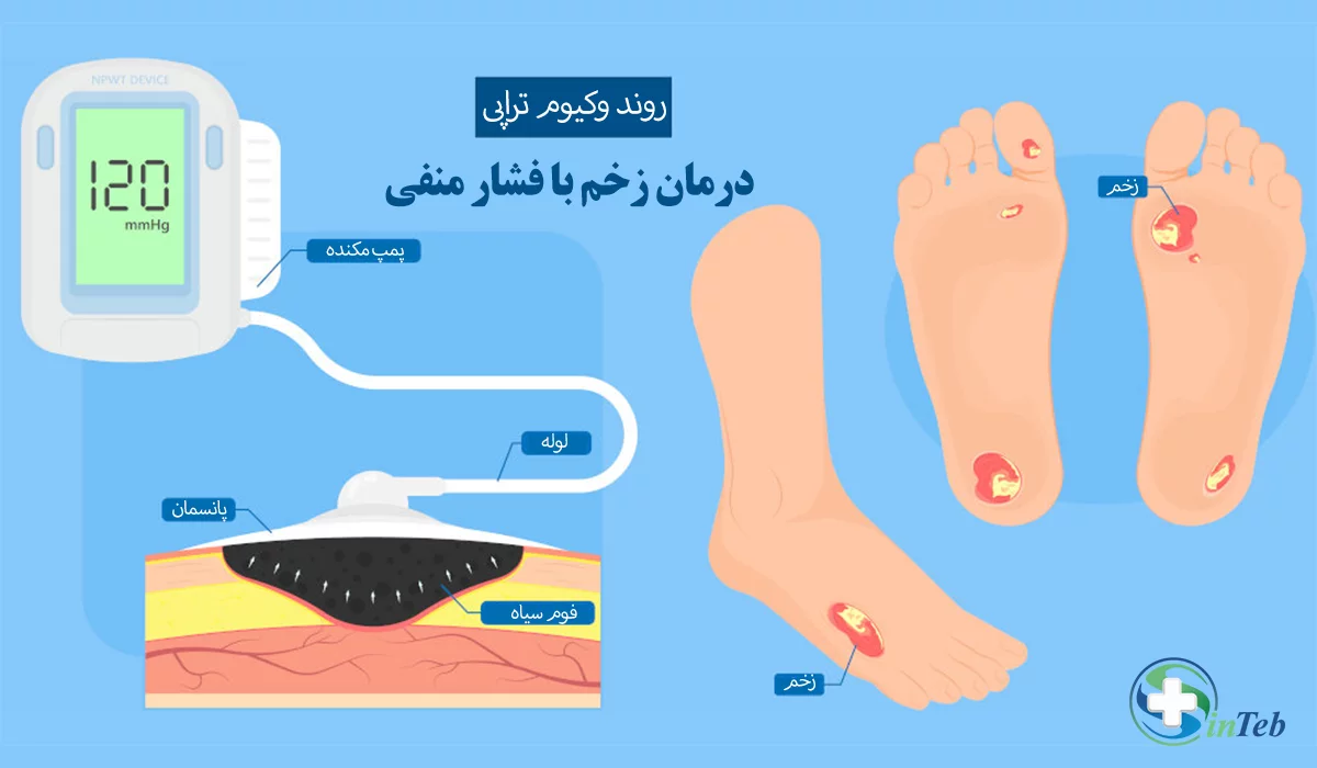 روند وکیوم تراپی زخم