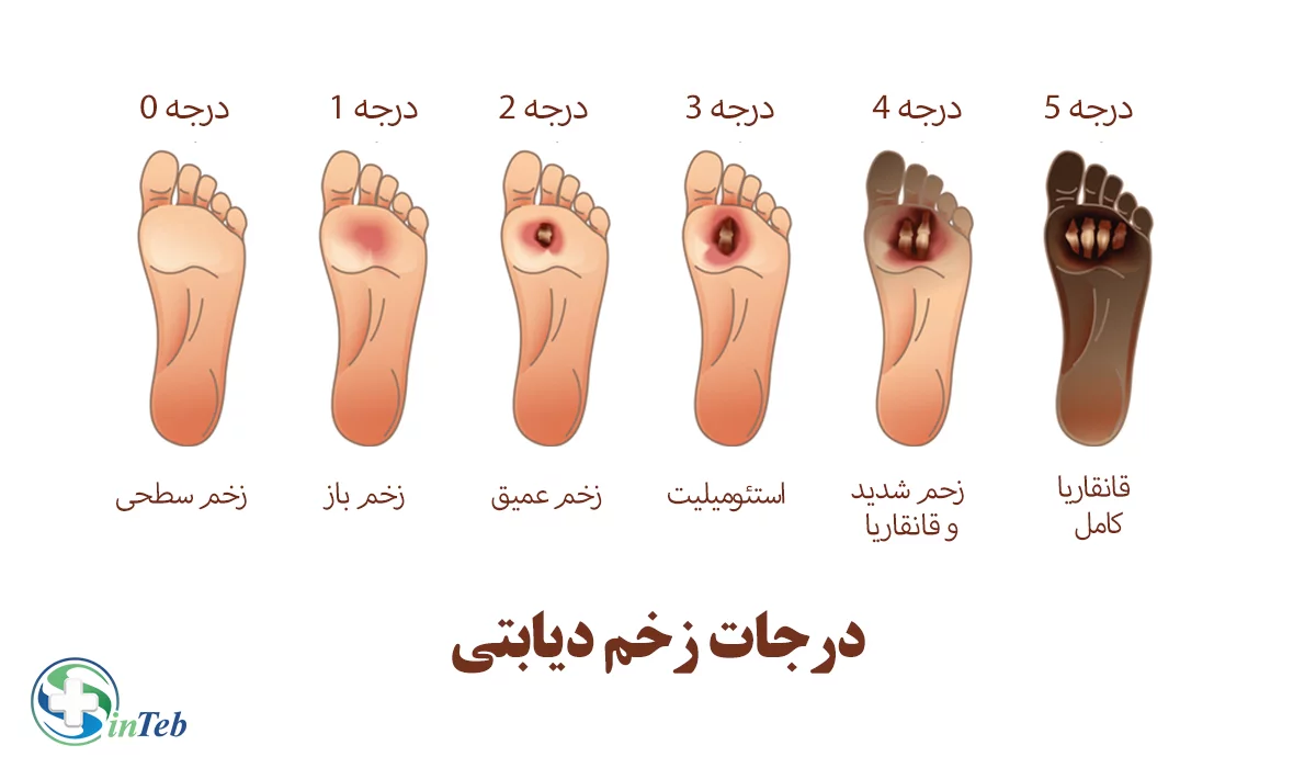 درجات زخم دیابتی