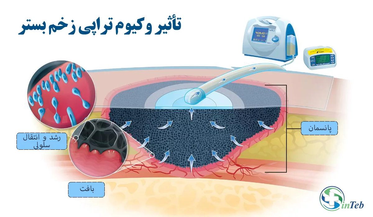 تأثیر وکیوم تراپی زخم بستر