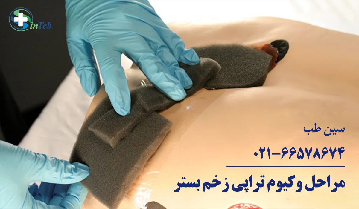 مراحل وکیوم تراپی