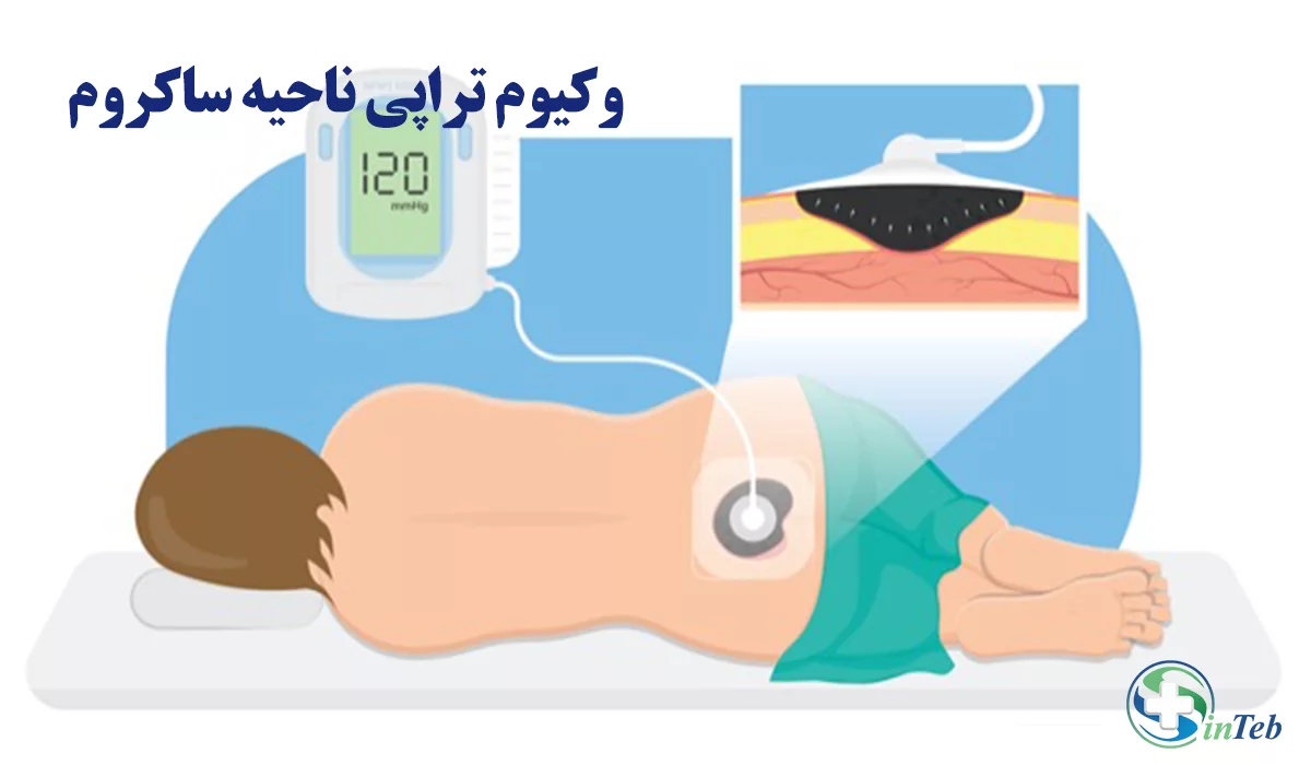 وکیوم تراپی ناحیه ساکروم