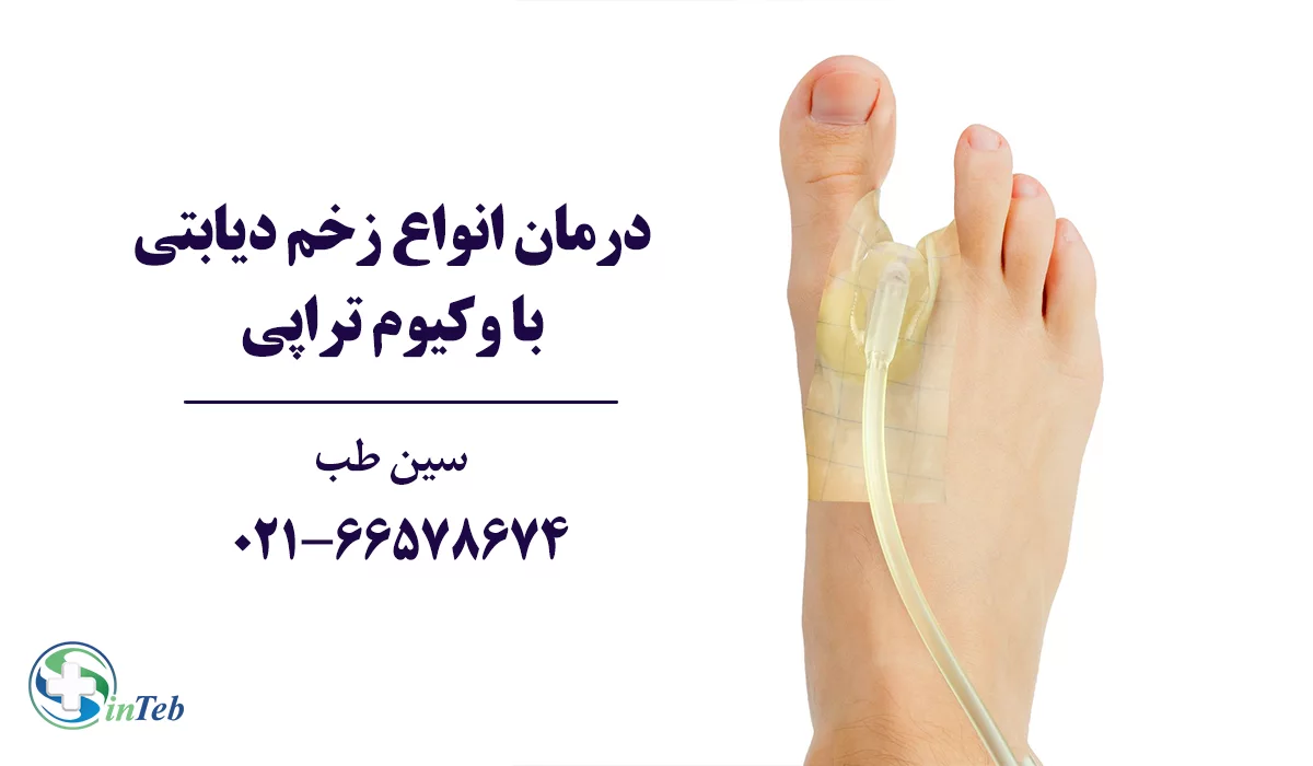درمان زخم دیابتی با وکیوم تراپی