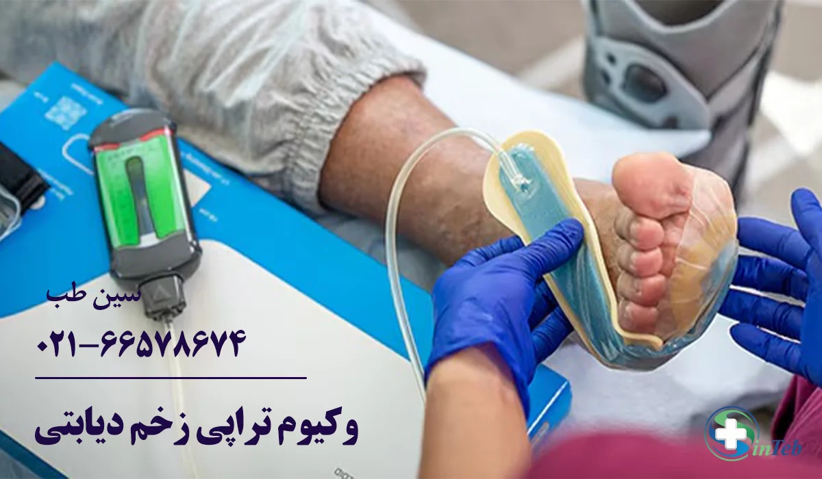 درمان زخم دیابتی با وکیوم تراپی