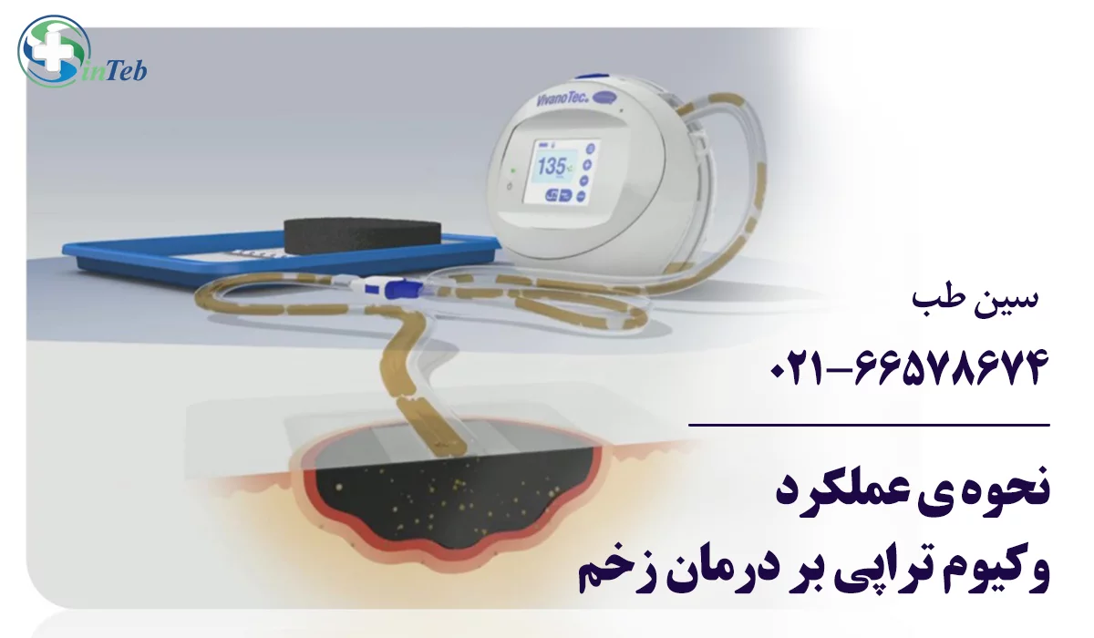 نحوه عملکرد وکیوم تراپی زخم