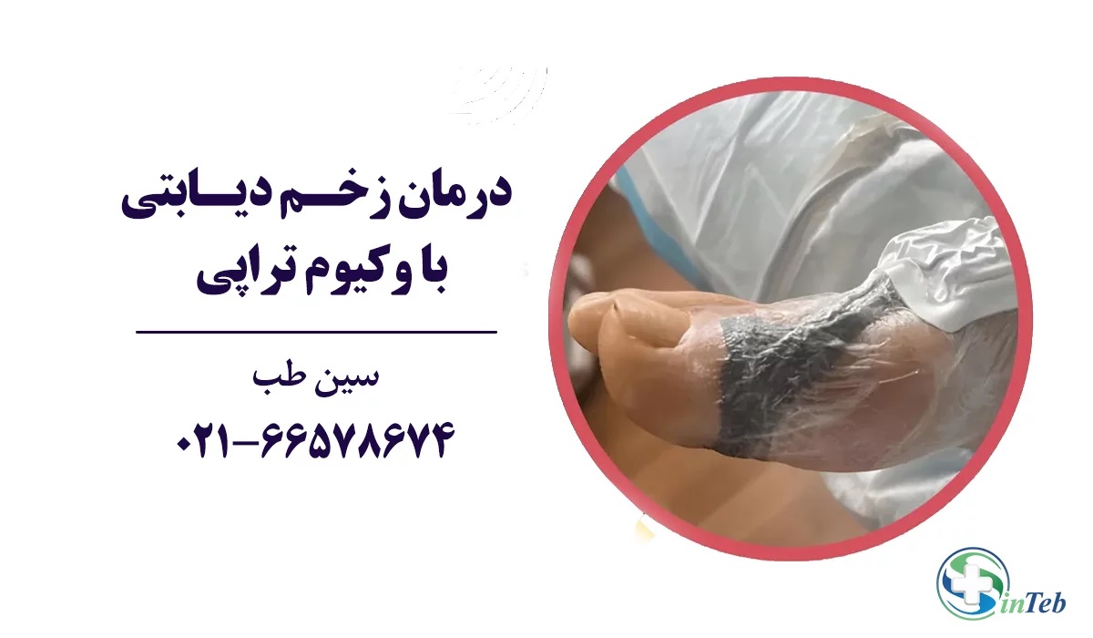 درمان زخم دیابتی با وکیوم تراپی