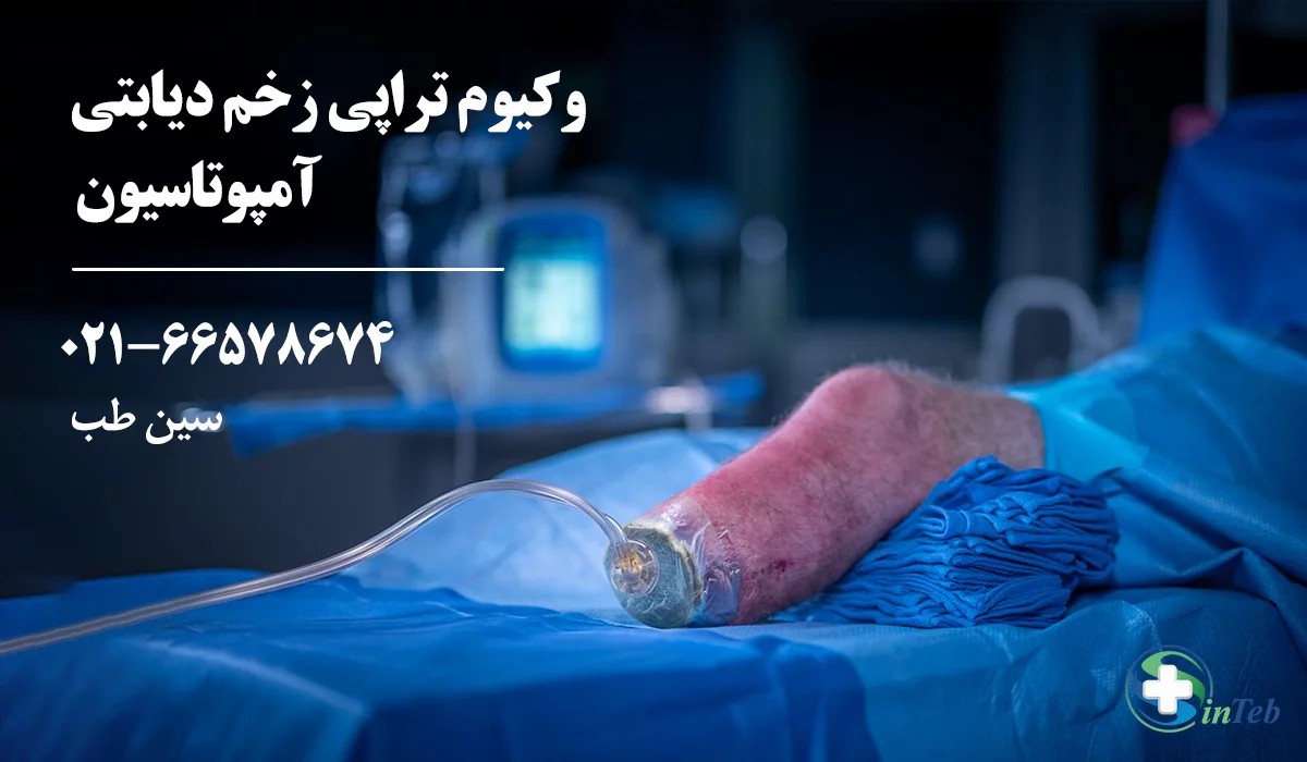 درمان زخم دیابتی با وکیوم تراپی