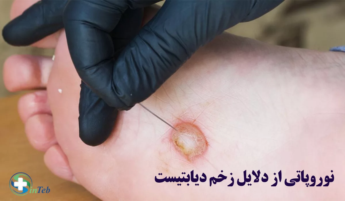 نوروپاتی دیابتی