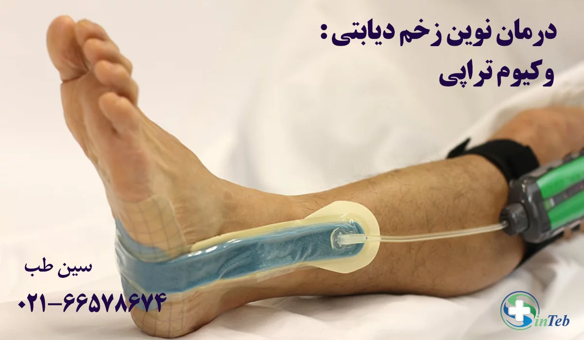 درمان زخم دیابتی با وکیوم تراپی