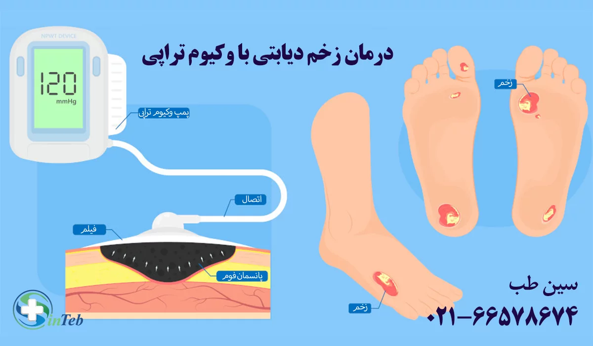 درمان زخم دیابتی با وکیوم تراپی