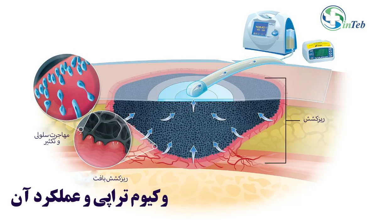 وکیوم تراپی و عملکرد آن