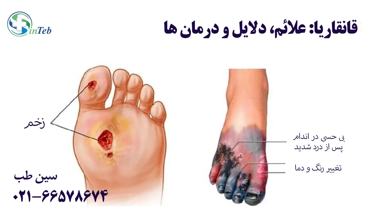 گانگرن یا قانقاریا