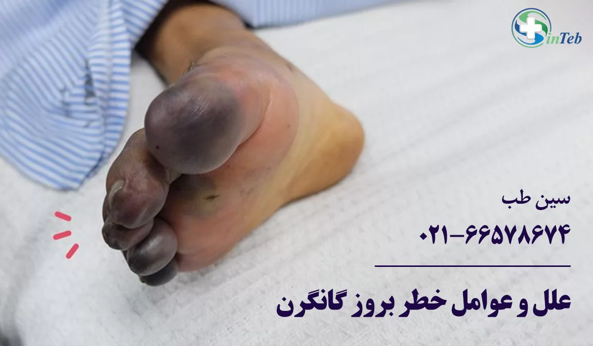 گانگرن یا قانقاریا