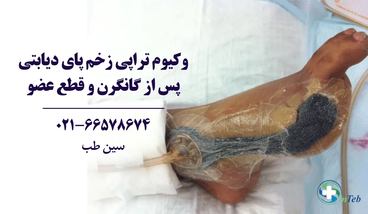 وکیوم تراپی گانگرن یا قانقاریا