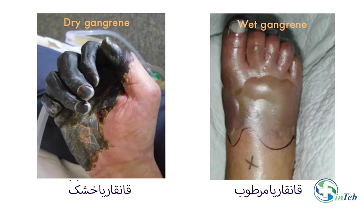 تفاوت انواع گانگرن یا قانقاریا