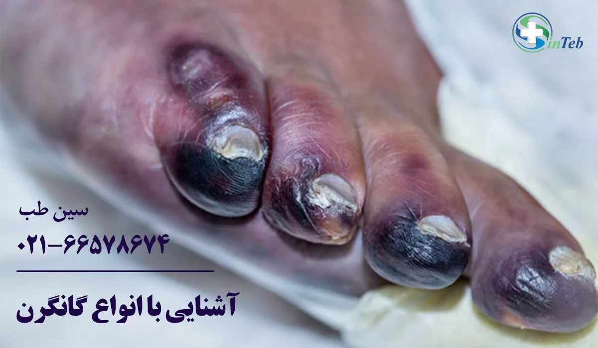 آشنایی با گانگرن یا قانقاریا