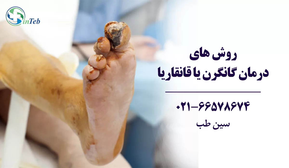 درمان گانگرن یا قانقاریا