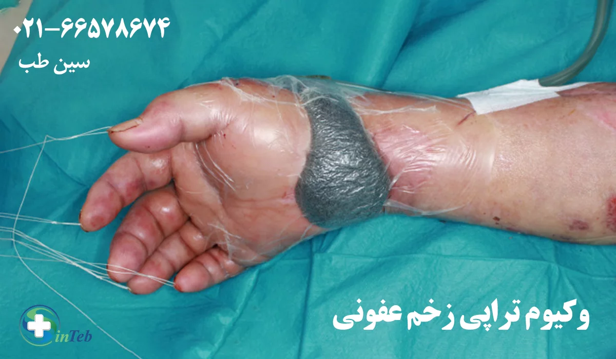 درمان زخم عفونی با وکیوم تراپی