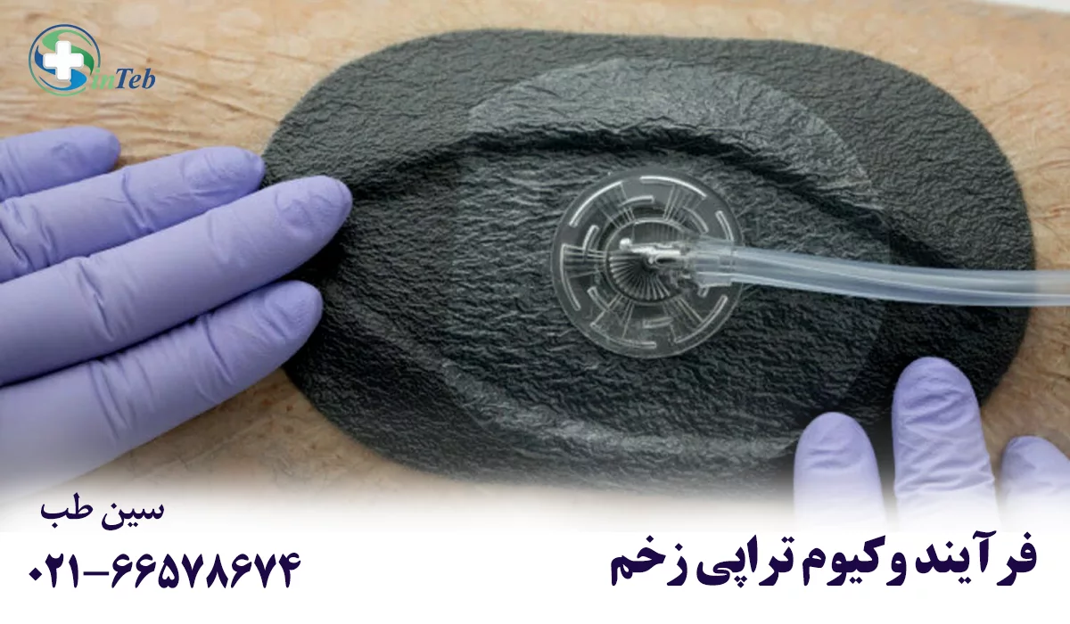 روند درمان زخم عفونی با وکیوم تراپی