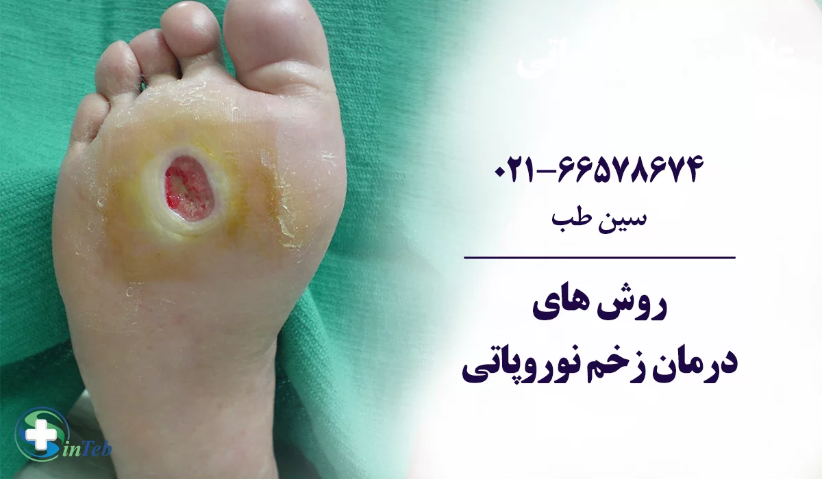روش های درمان زخم نوروپاتی