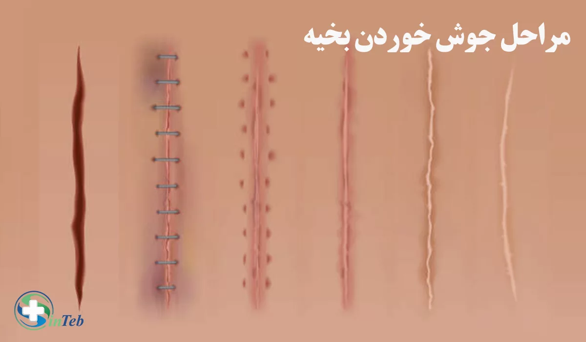 مراحل جوش خوردن بخیه زخم