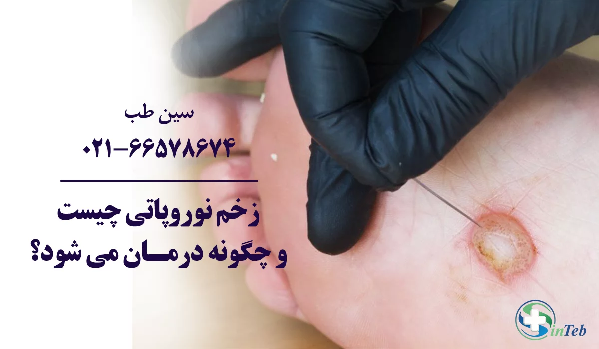 زخم نوروپاتی چیست و چگونه درمان می شود؟