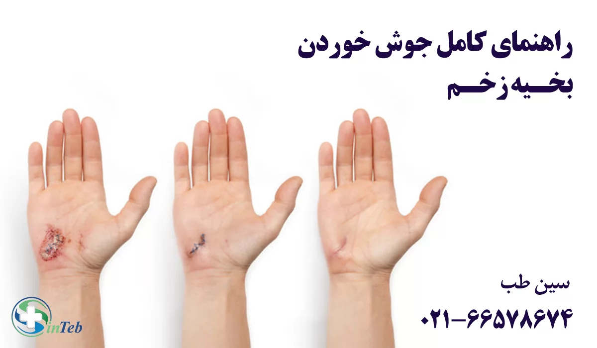 راهنمای کامل جوش خوردن بخیه زخم